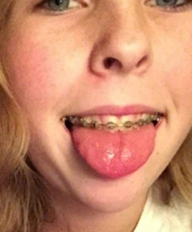 Cum on teen braces