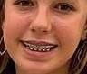 Cum on teen braces