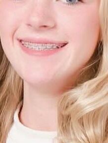 Cum on teen braces