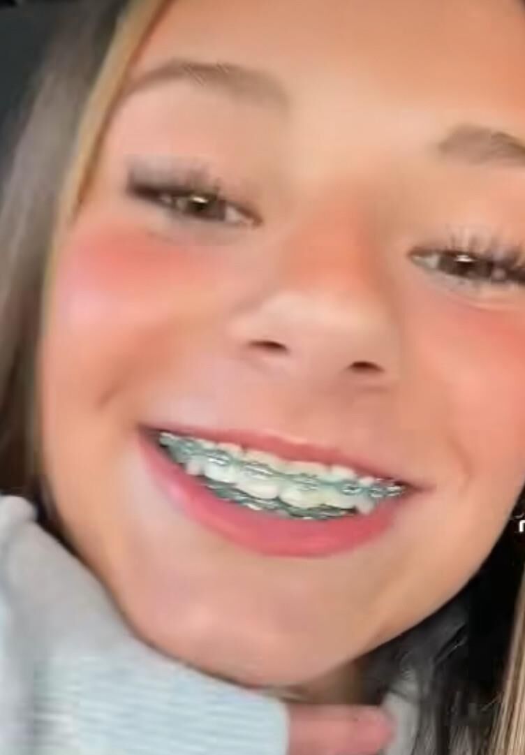 Cum on teen braces