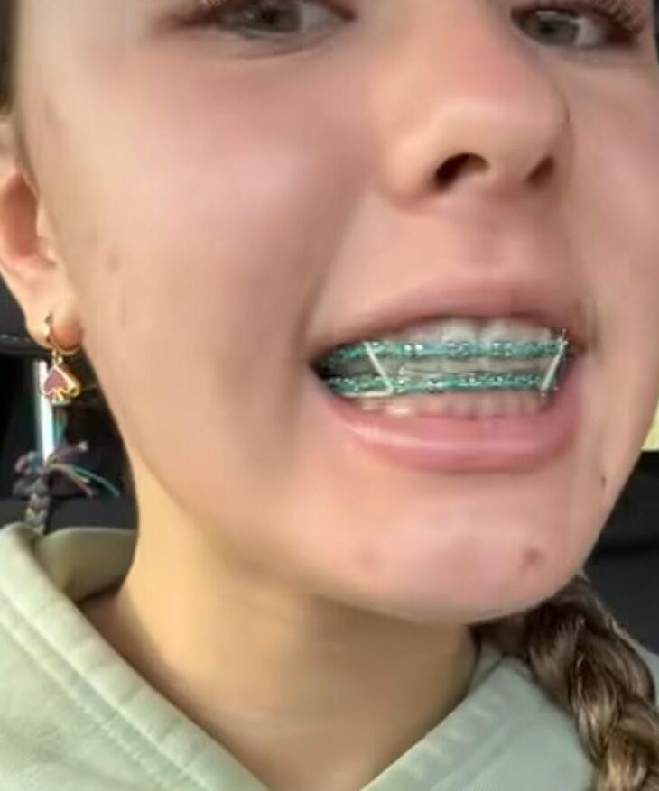 Cum on teen braces