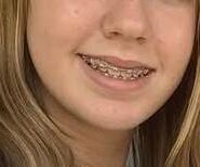 Cum on teen braces