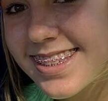 Cum on teen braces