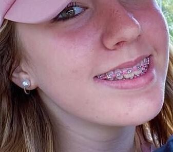 Cum on teen braces