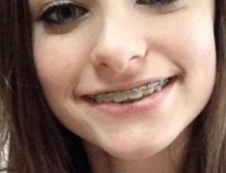 Cum on teen braces