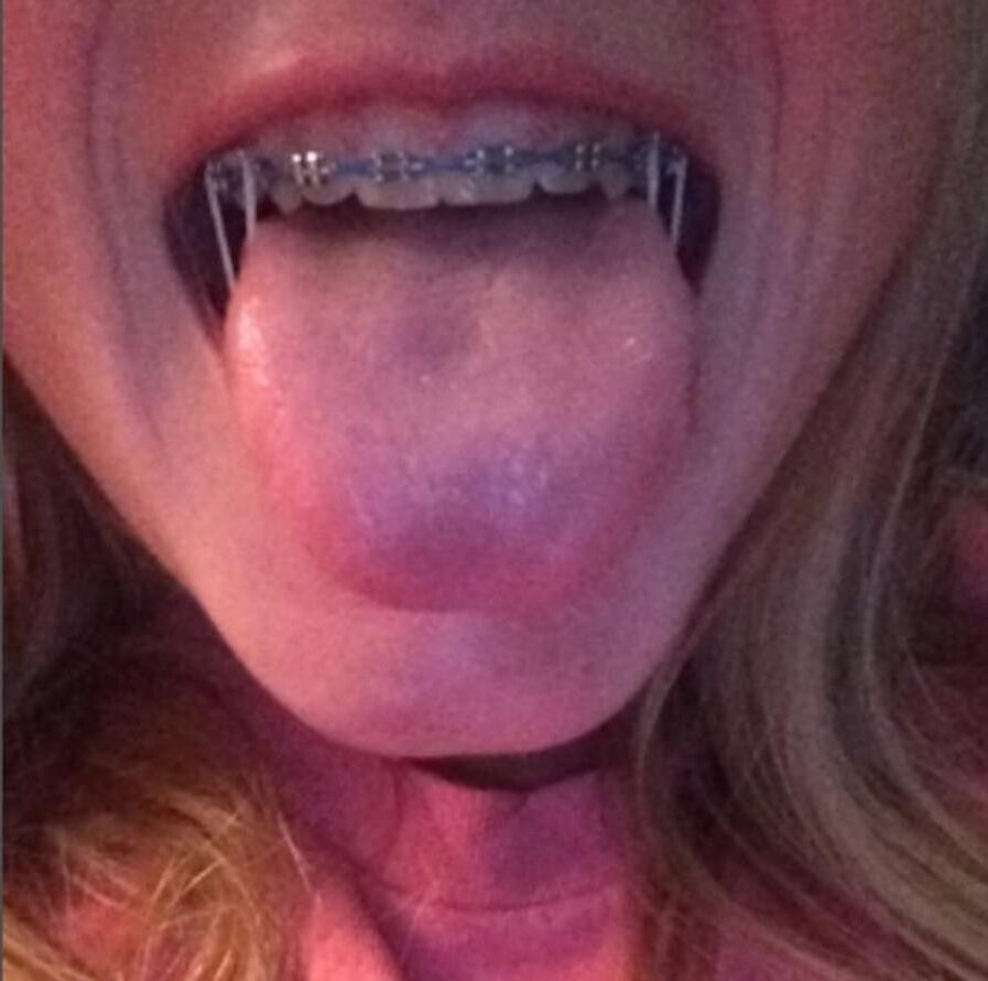 Cum on teen braces
