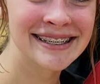 Cum on teen braces