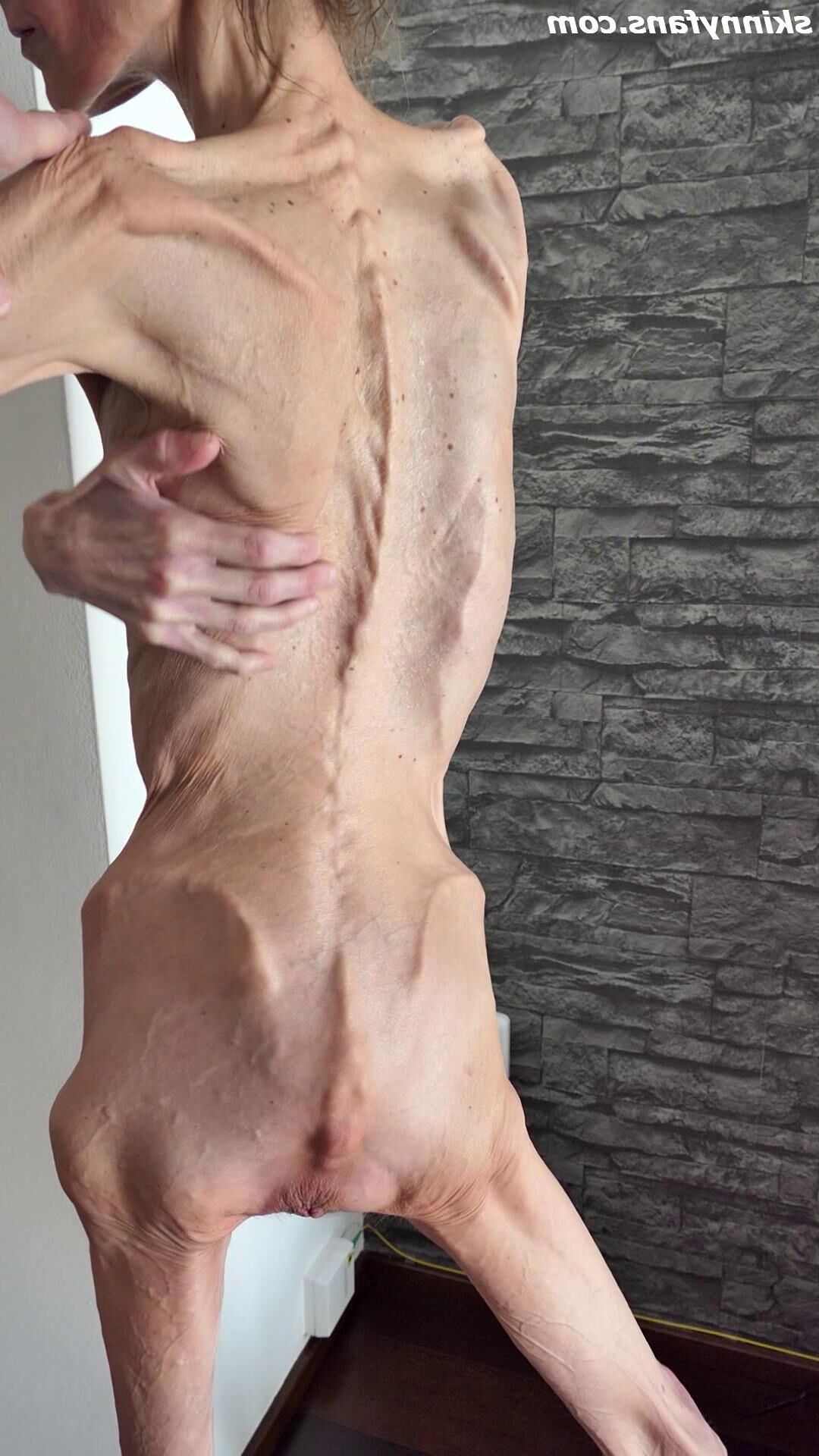 Denisa anorexic skinny fragile mager duenn knochig bones 