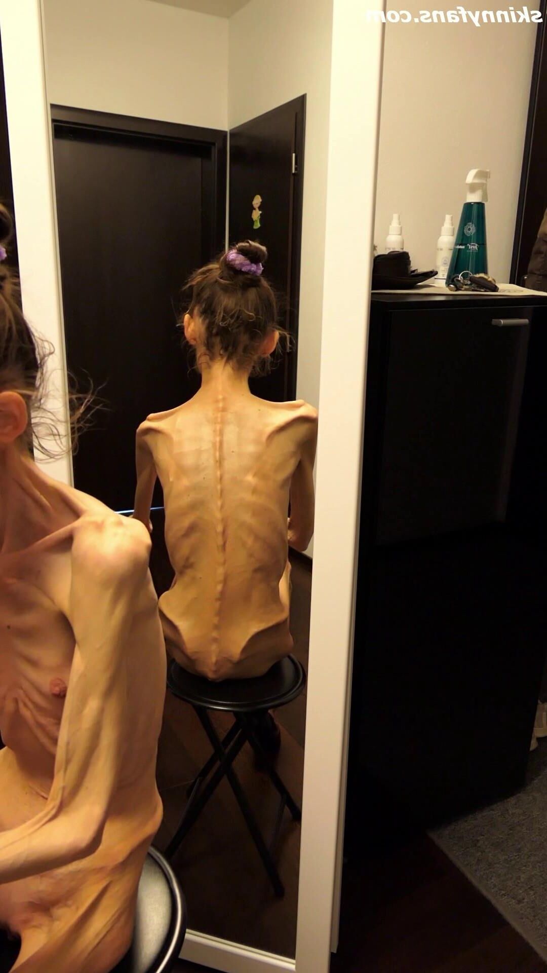 Denisa anorexique maigre maigre mageur Duenn Knochig Bones