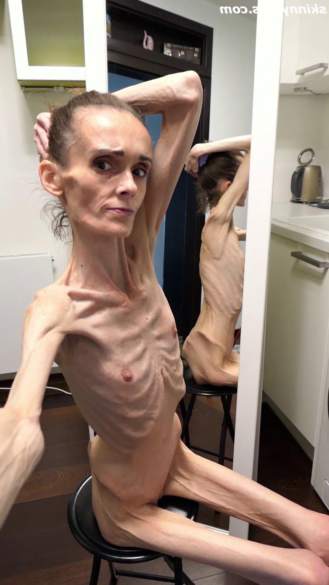 Denisa anorexique maigre maigre mageur Duenn Knochig Bones