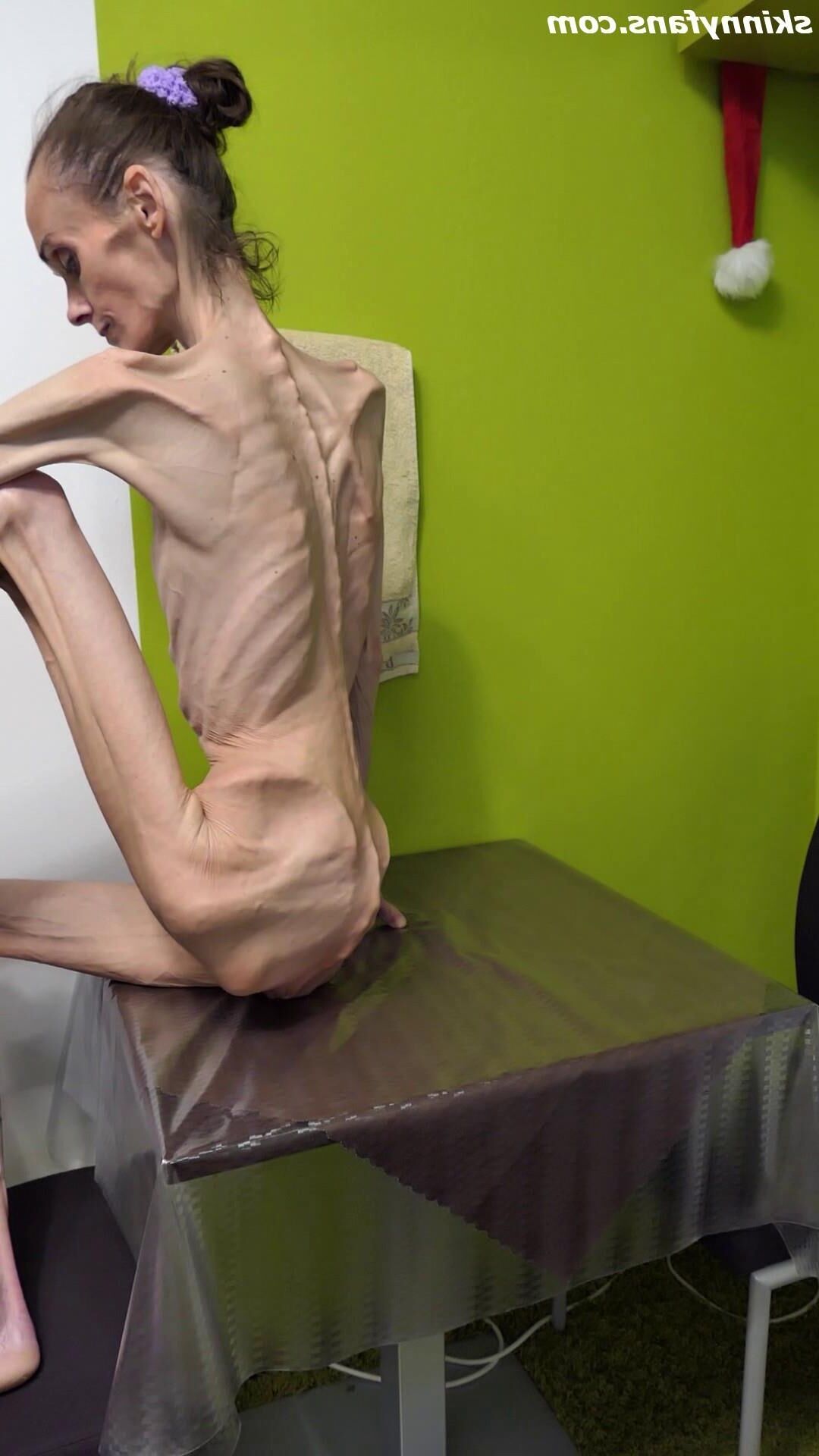 Denisa anorexique maigre maigre mageur Duenn Knochig Bones