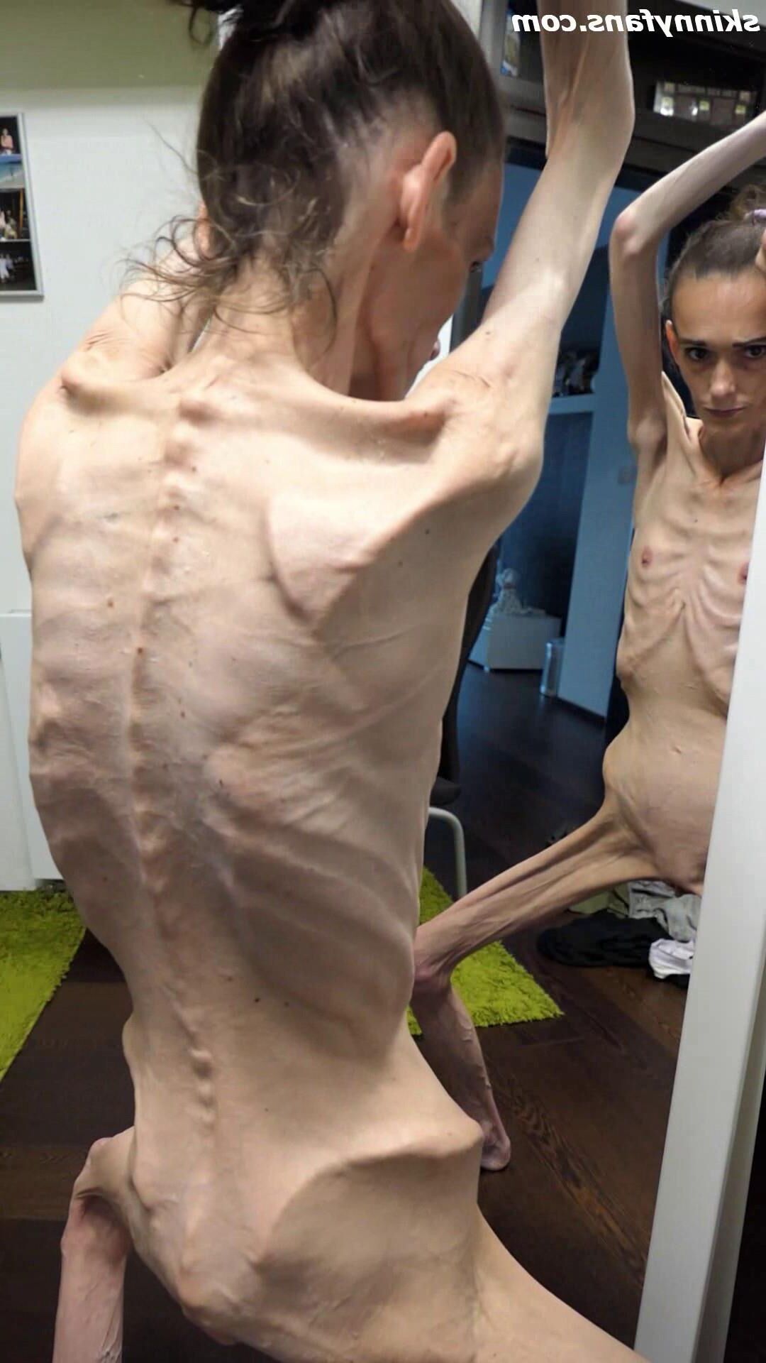 Denisa anorexique maigre maigre mageur Duenn Knochig Bones