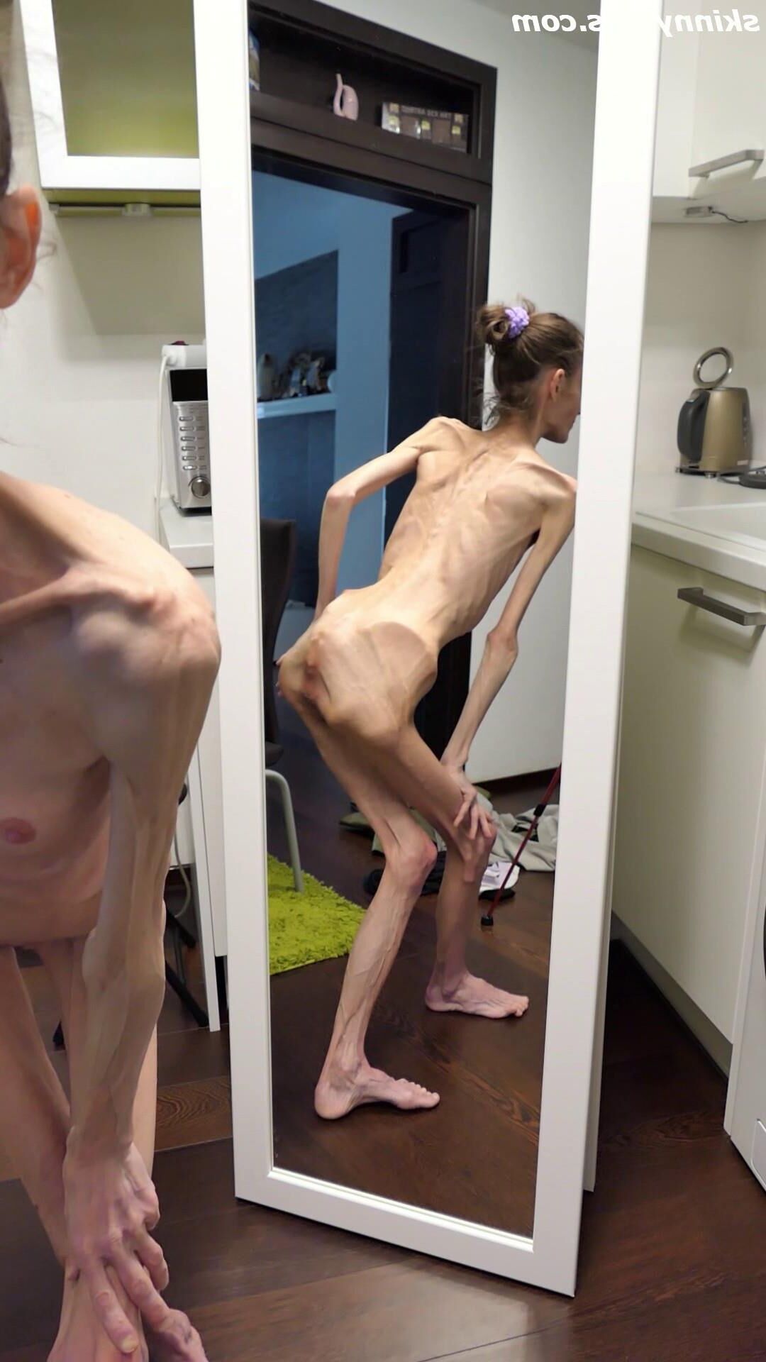 Denisa anorexique maigre maigre mageur Duenn Knochig Bones