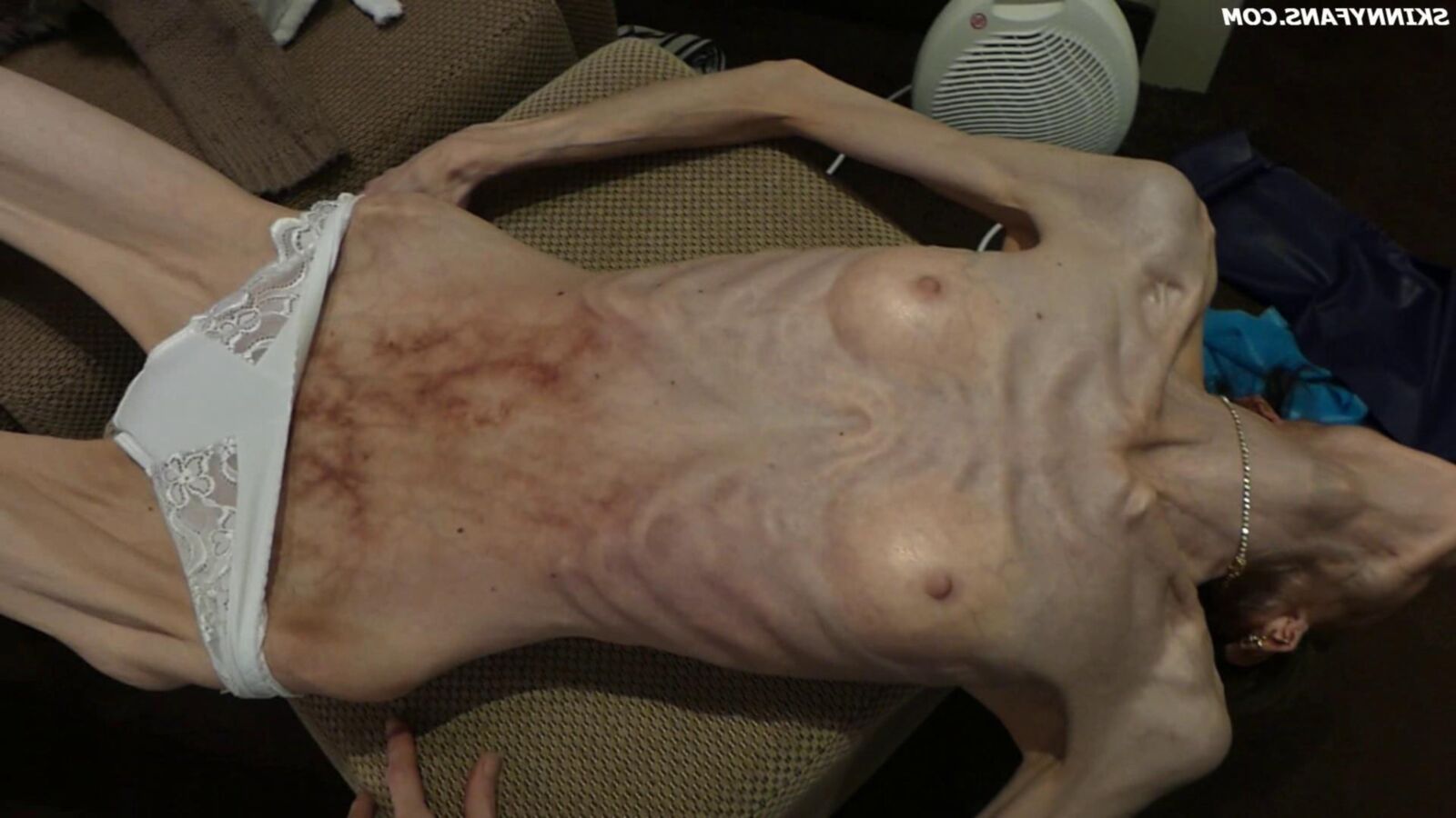 Gina anoréxica skinny frágil Mager Duenn Knochig Bones