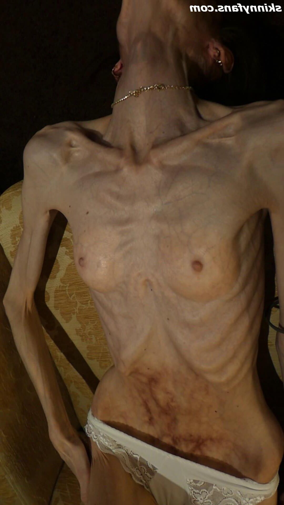 Gina anoréxica skinny frágil Mager Duenn Knochig Bones
