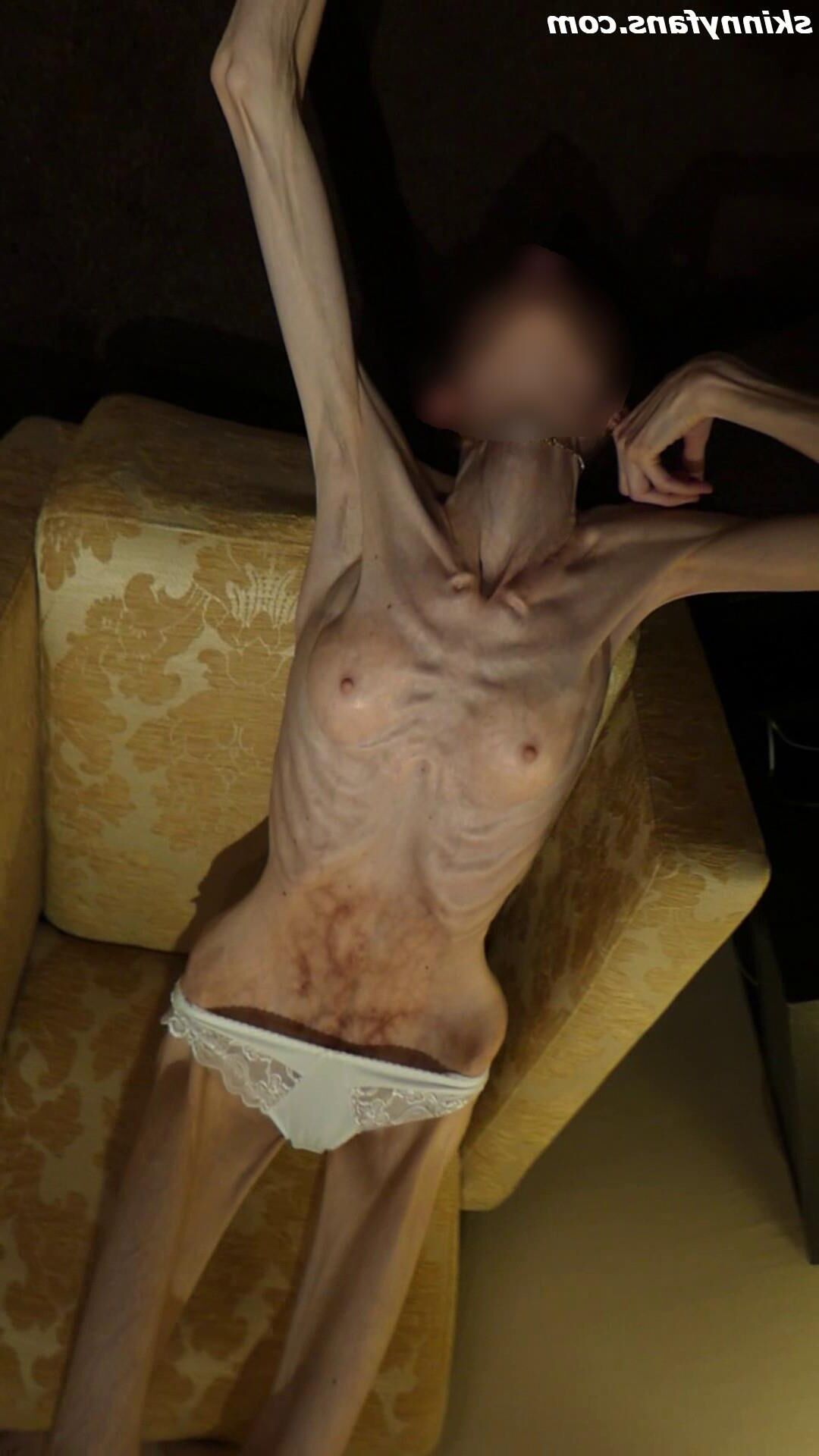 Gina anoréxica skinny frágil Mager Duenn Knochig Bones