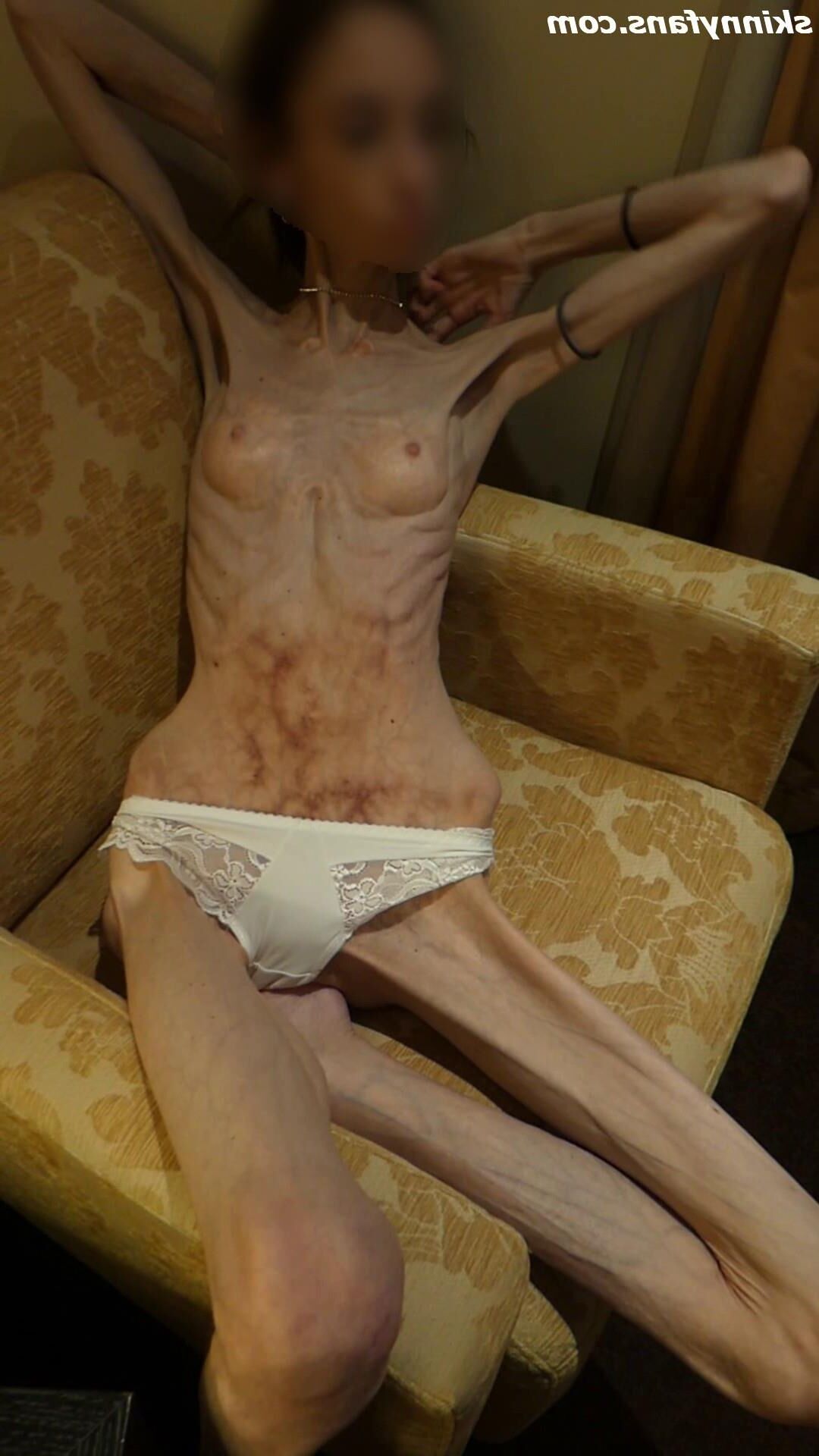 Gina anoréxica skinny frágil Mager Duenn Knochig Bones