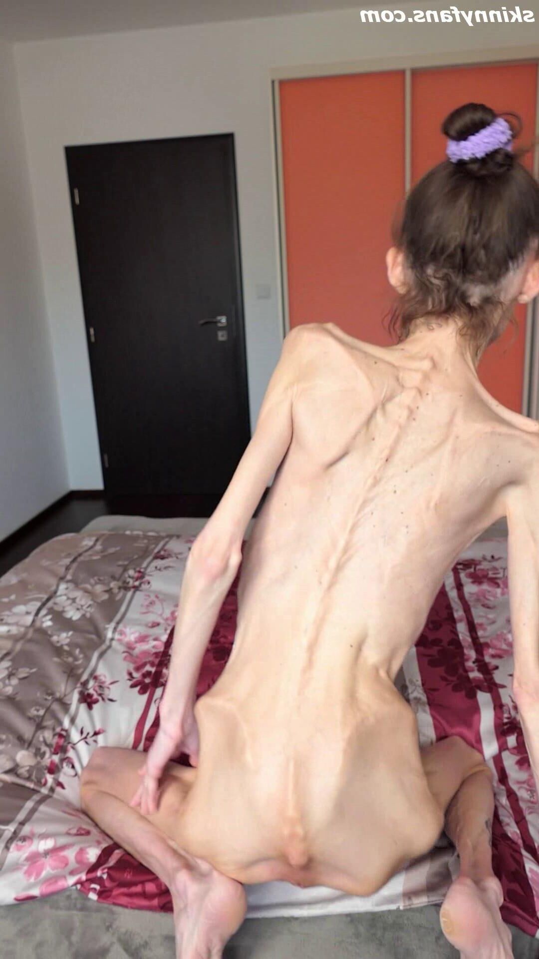 Denisa anoréxico flaco frágil mager duenn knochig huesos