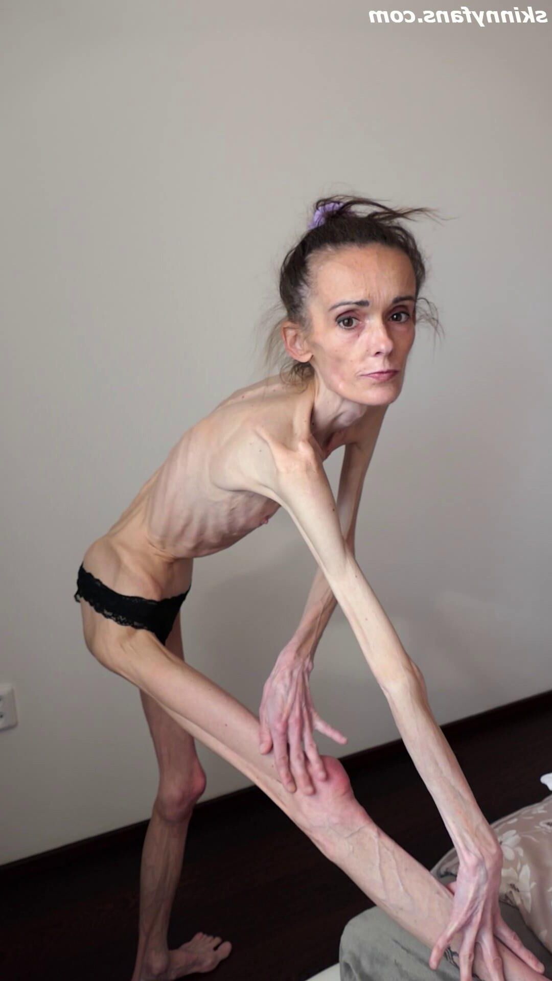 Denisa anoréxico flaco frágil mager duenn knochig huesos