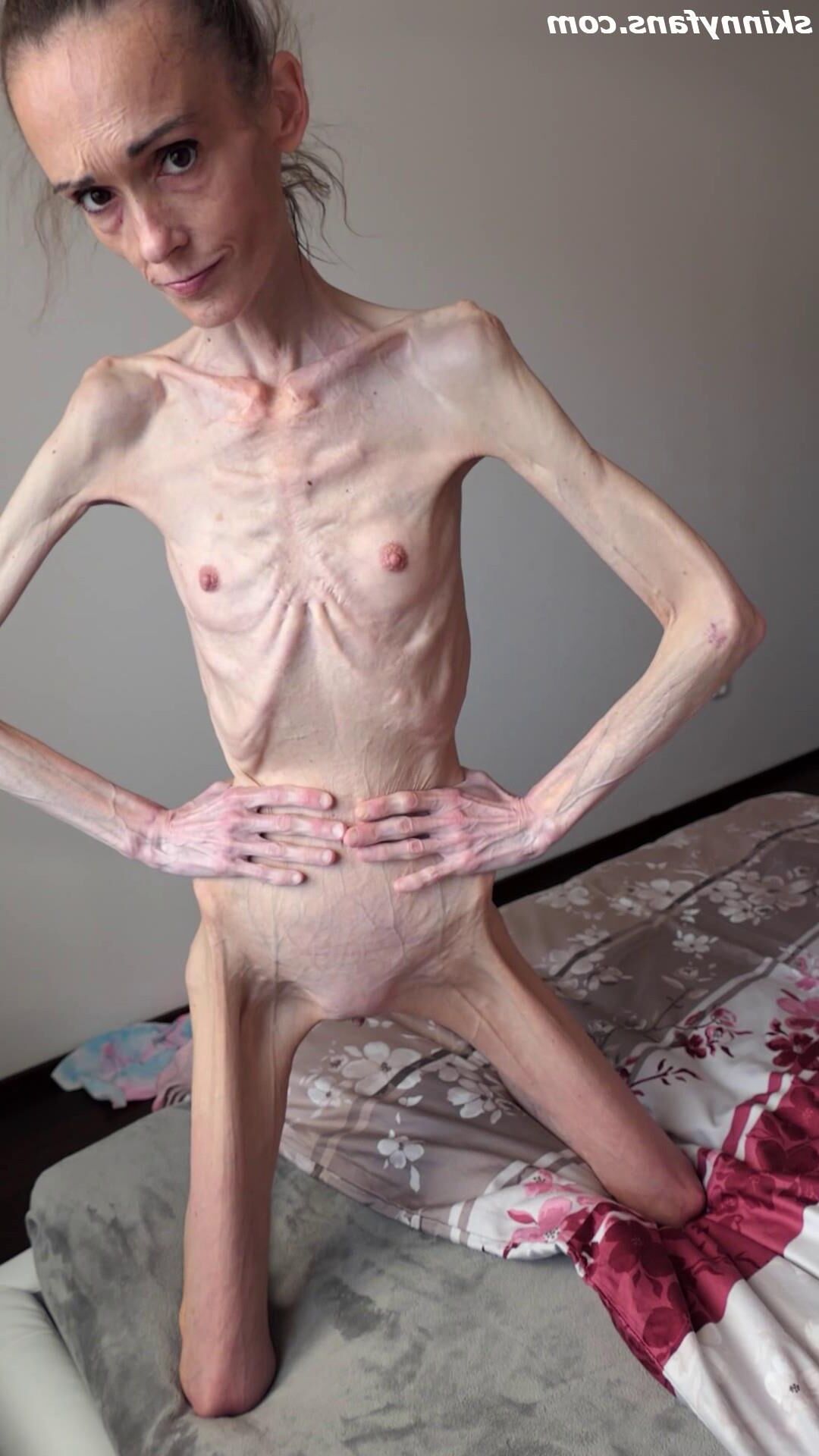 Denisa anoréxico flaco frágil mager duenn knochig huesos