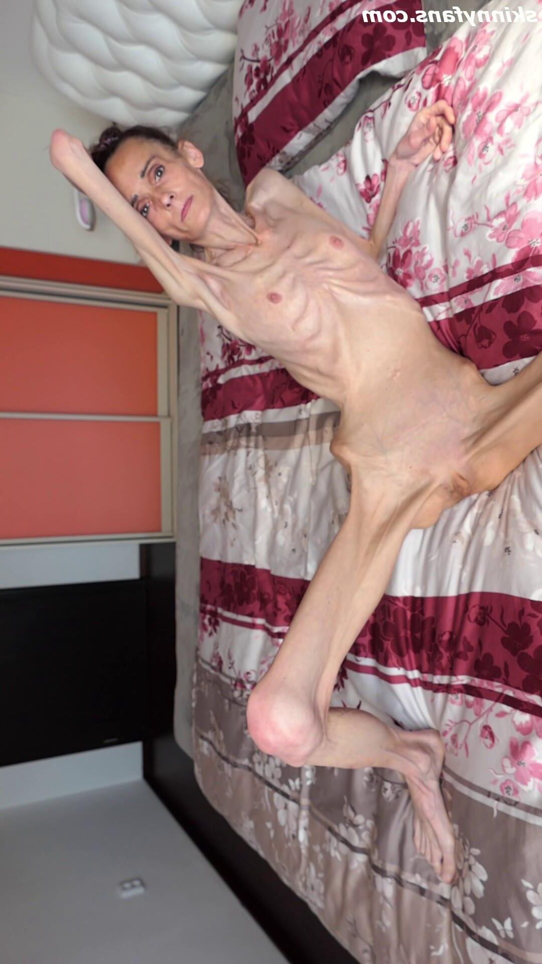Denisa anoréxico flaco frágil mager duenn knochig huesos