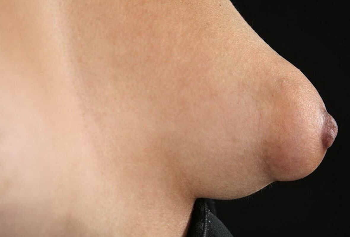 nipples 
